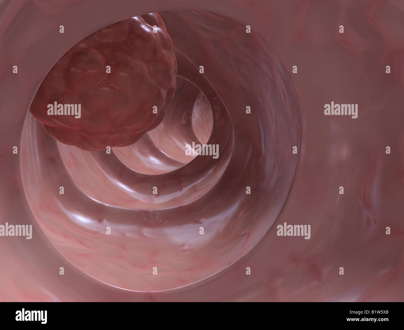Colon cancer x ray hires stock photography and images Alamy