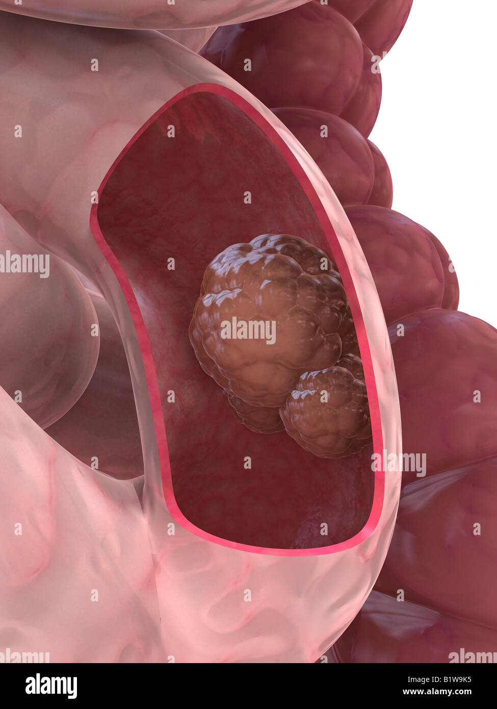 cancer in small intestine Stock Photo