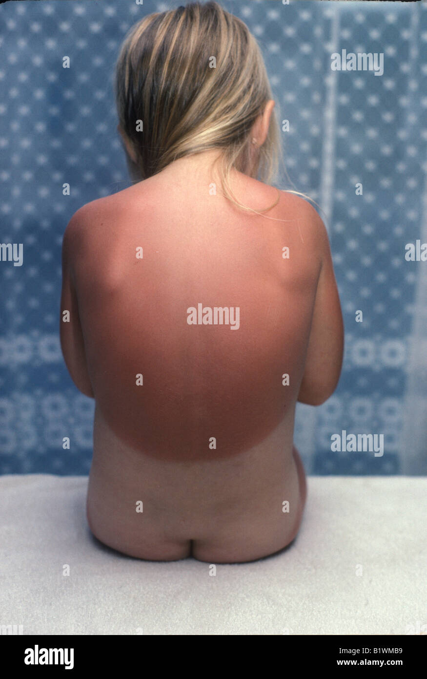 teen girl sunburn Teen girl sunburn