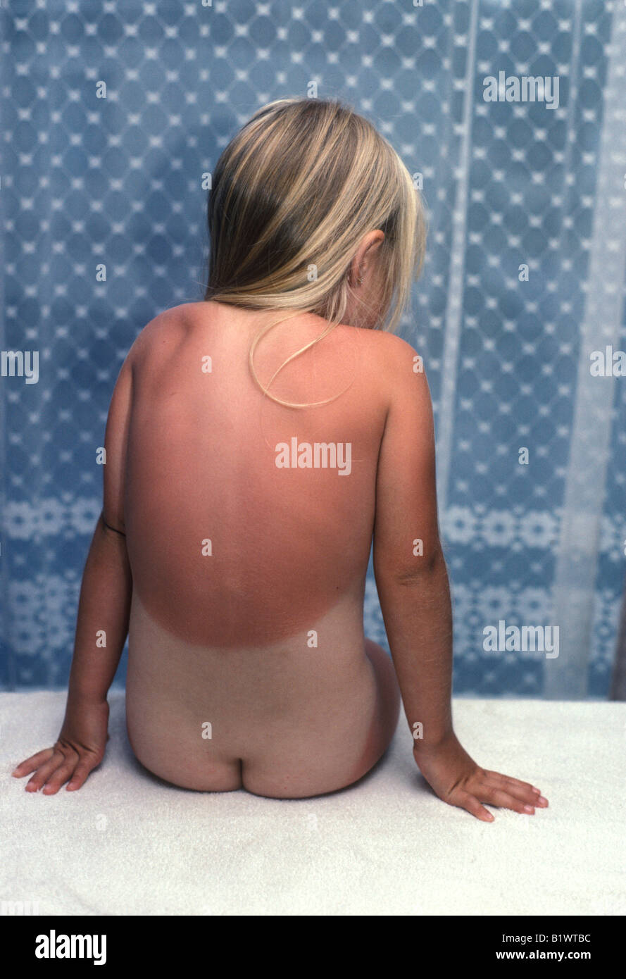 back view of little girl with serious sunburn, showing border between burnt and unburnt Stock Photo