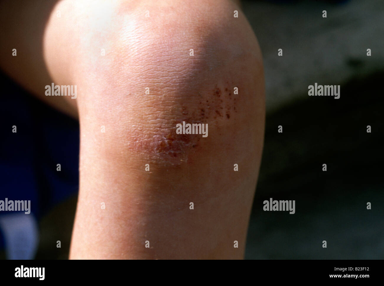 Grazed injury hi-res stock photography and images - Alamy