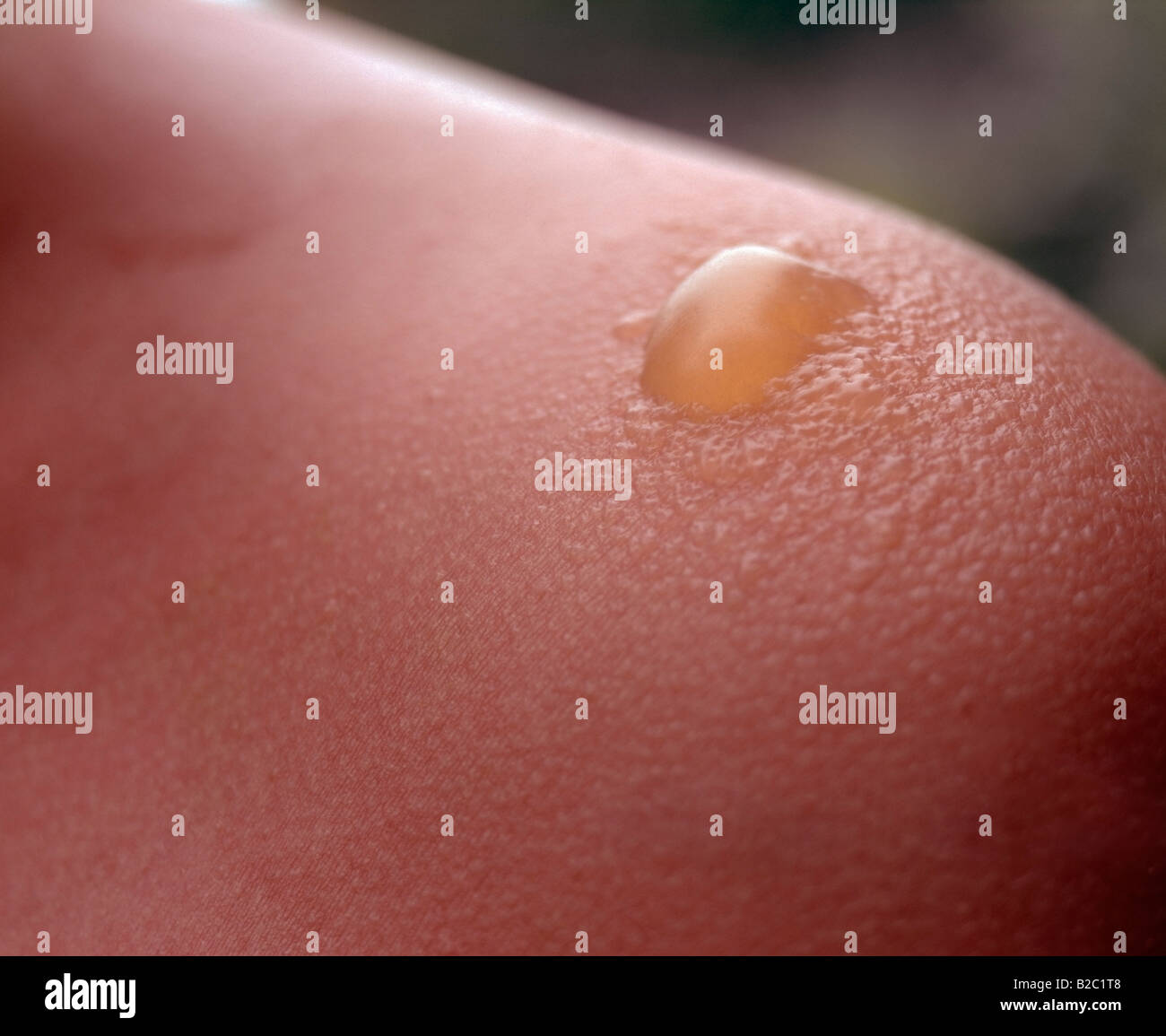 Close up of a severe sunburn blister on a childs shoulder. Stock Photo