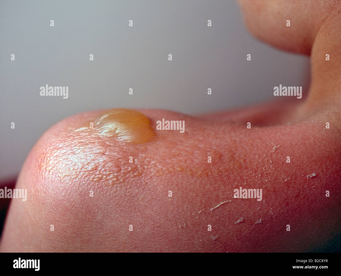 Close up of a severe second degree sunburn blister. Stock Photo