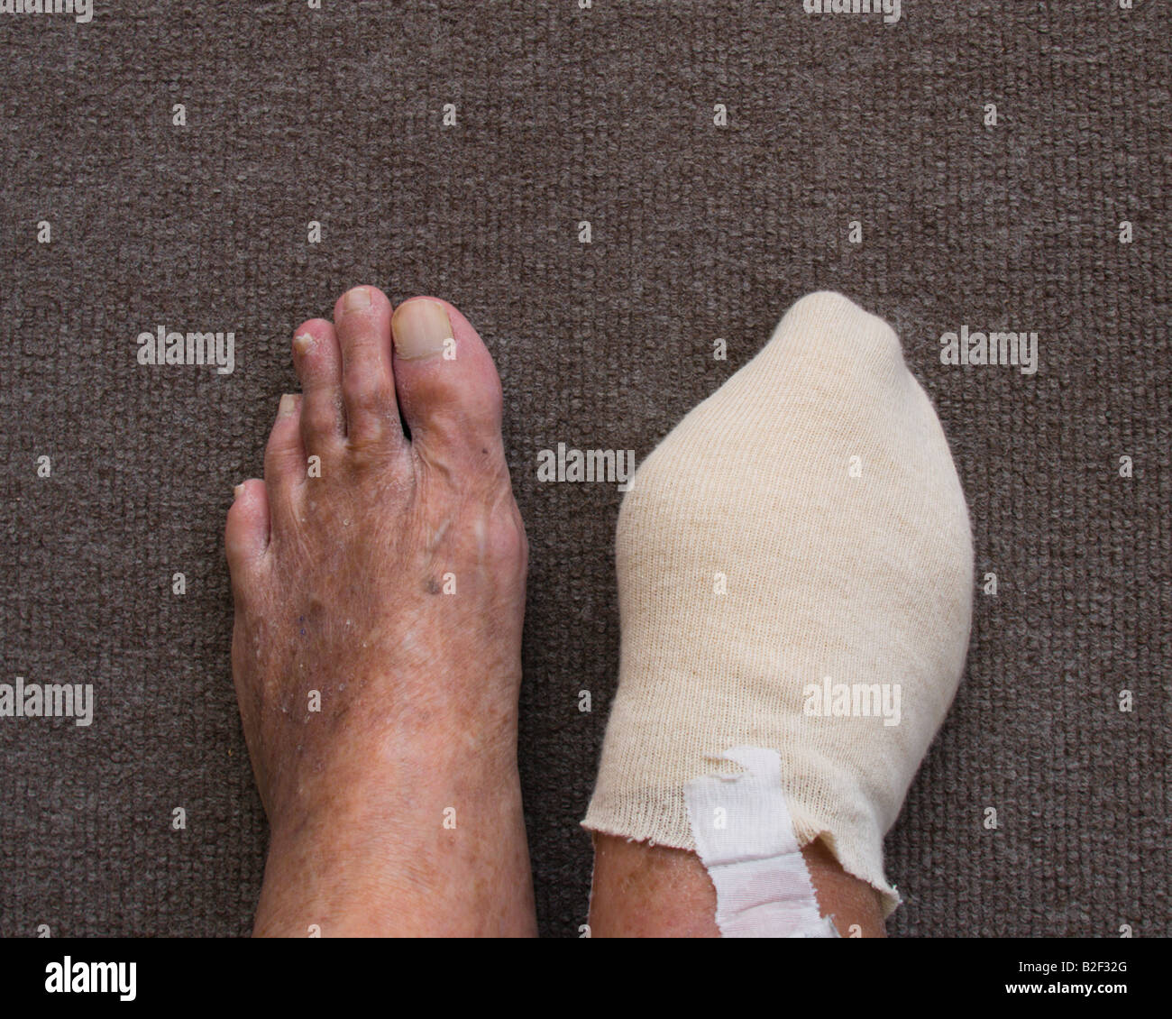 DIABETIC NEUROPATHY RESULTED IN AN INFECTION WHICH CAUSED THE AMPUTATION OF THE RIGHT BIG TOE OF THIS PATIENT Stock Photo