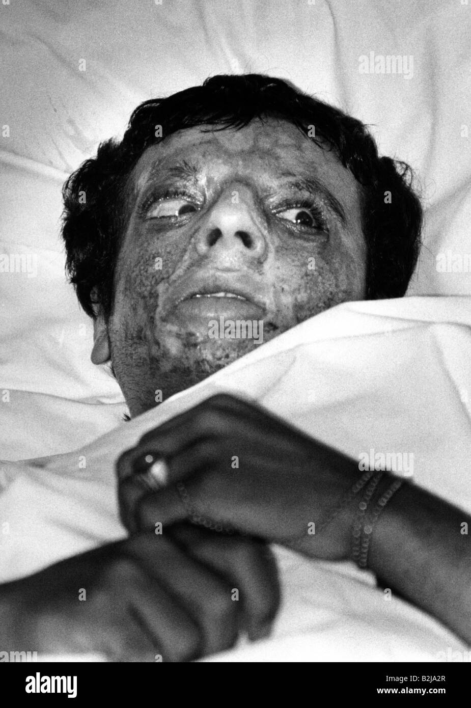 events, Iran-Iraq War 1980 - 1988, by poisen gas wounded man in a hospital, Irak, circa 1985, victims, chemical warfare, medical service, Iran, 20th century, historic, historical, people, 1980s, Stock Photo