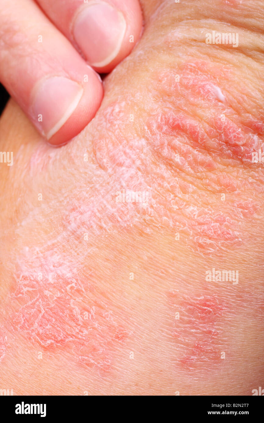 applying an emoillent to dry flaky skin as in the treatment of psoriasis  eczema and other dry skin conditions Stock Photo - Alamy
