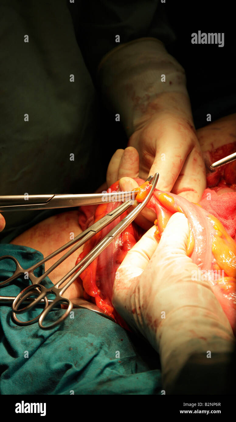 Surgeons clipping colon using Kelly surgical instrument to remove cancerous section and restitch Stock Photo