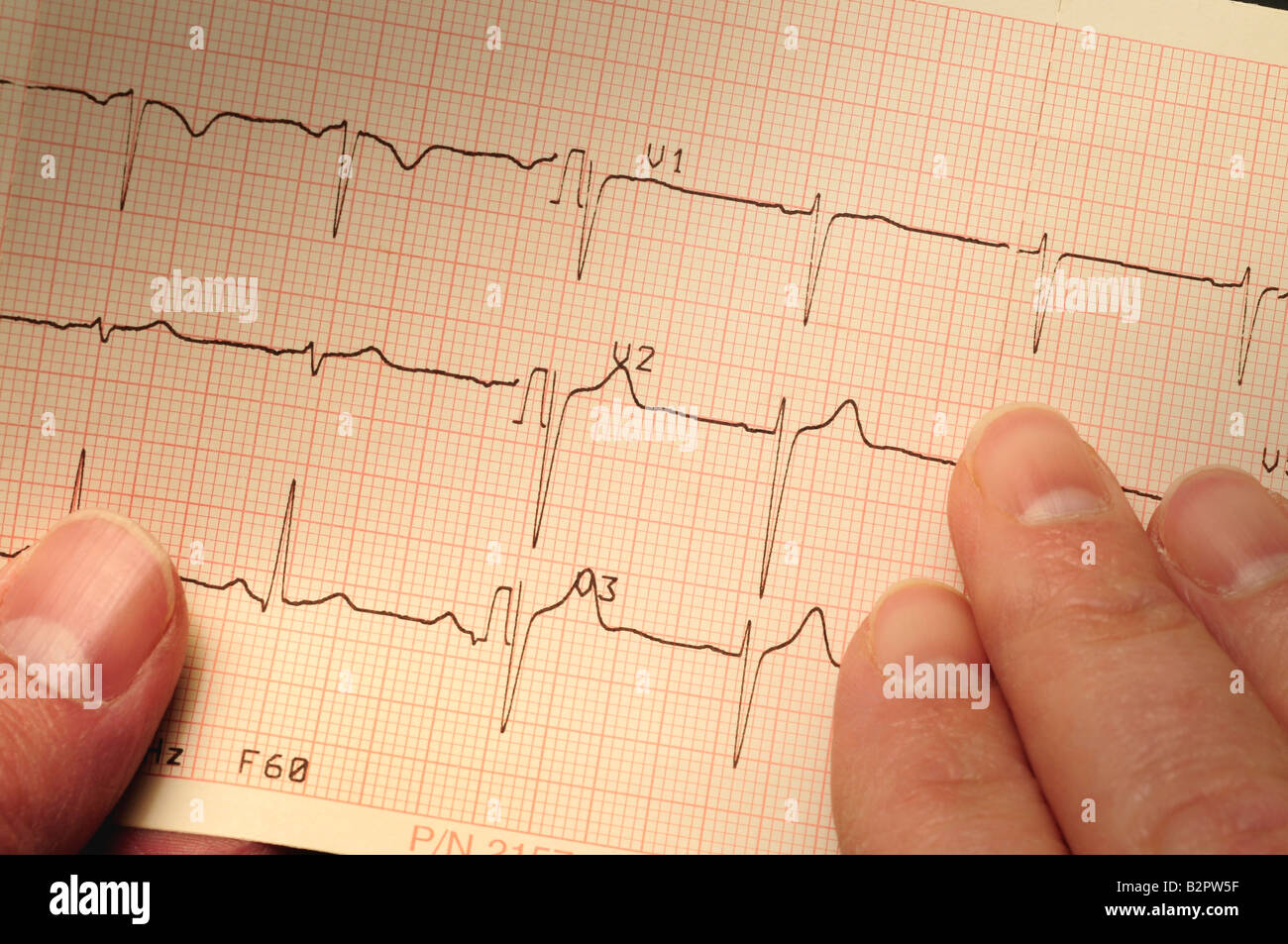 Electrocardiogram ekg hi-res stock photography and images - Alamy