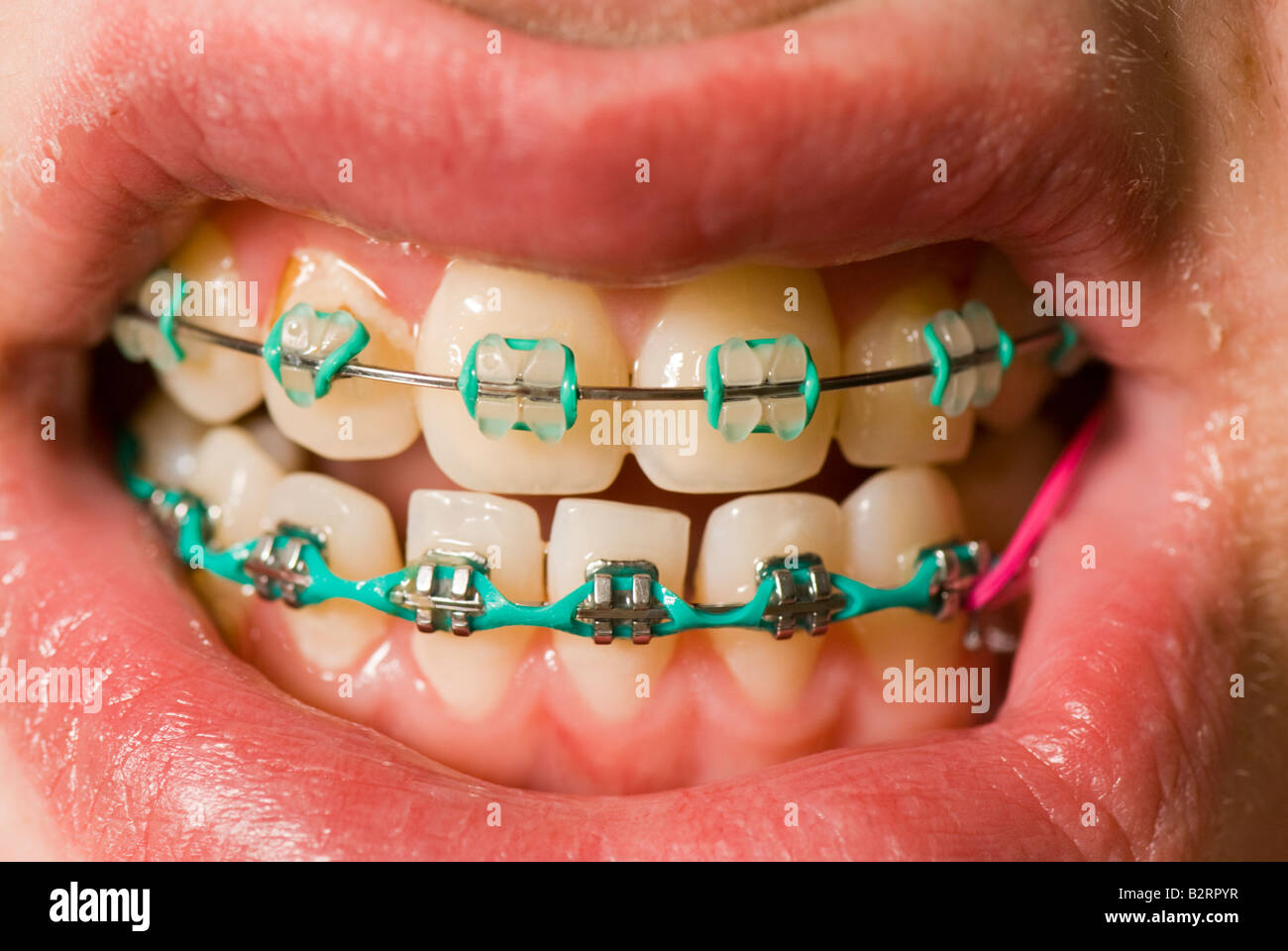 Orthodontic straighten hi-res stock photography and images - Alamy