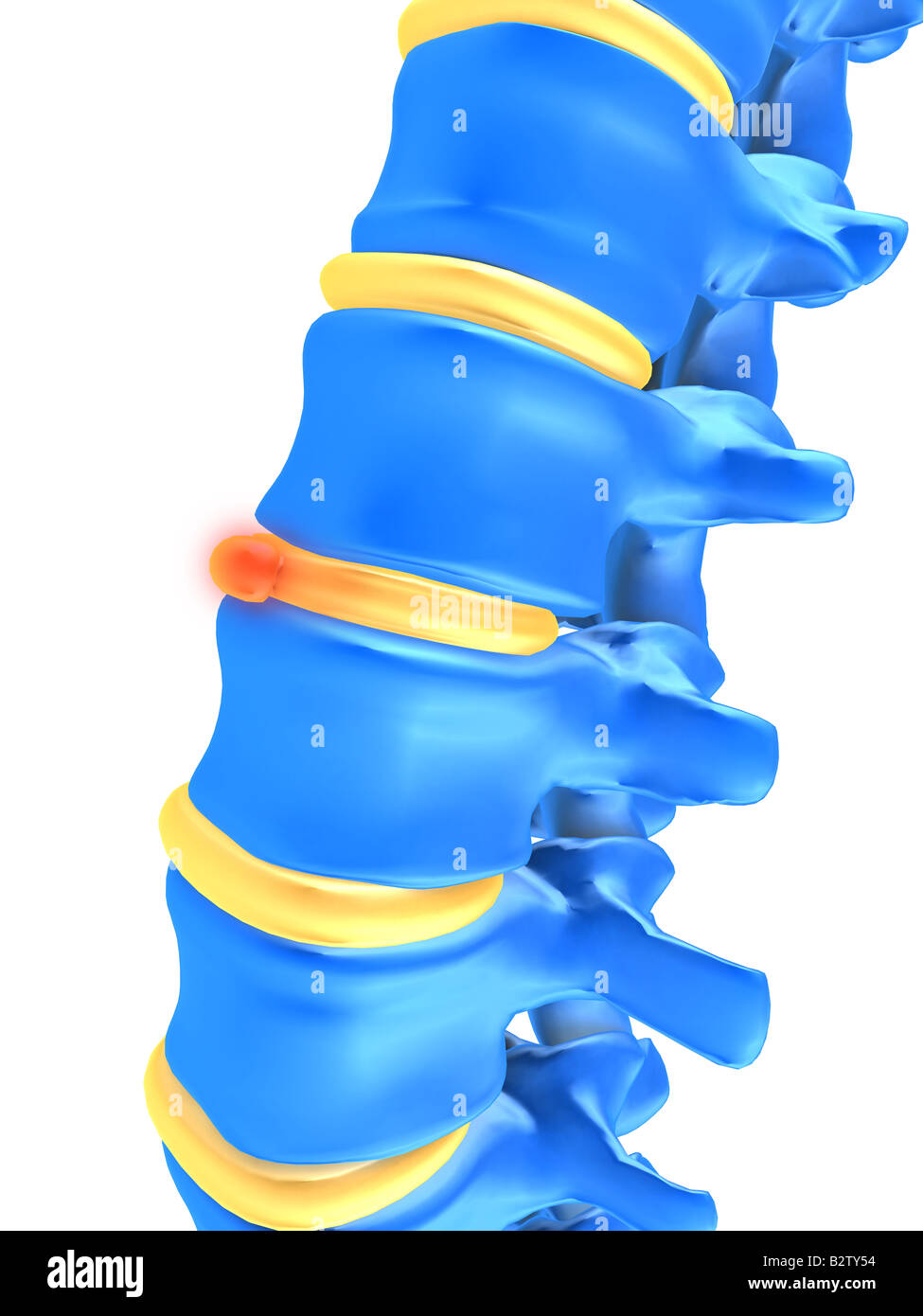 Slipped Disc High Resolution Stock Photography and Images Alamy