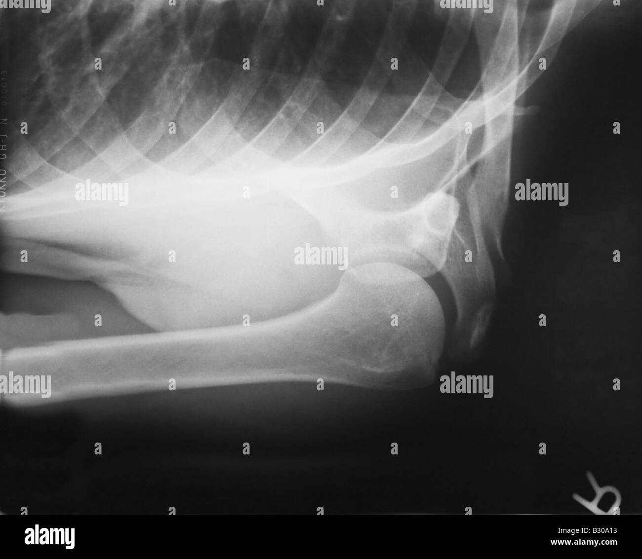 X ray of human shoulder Stock Photo Alamy