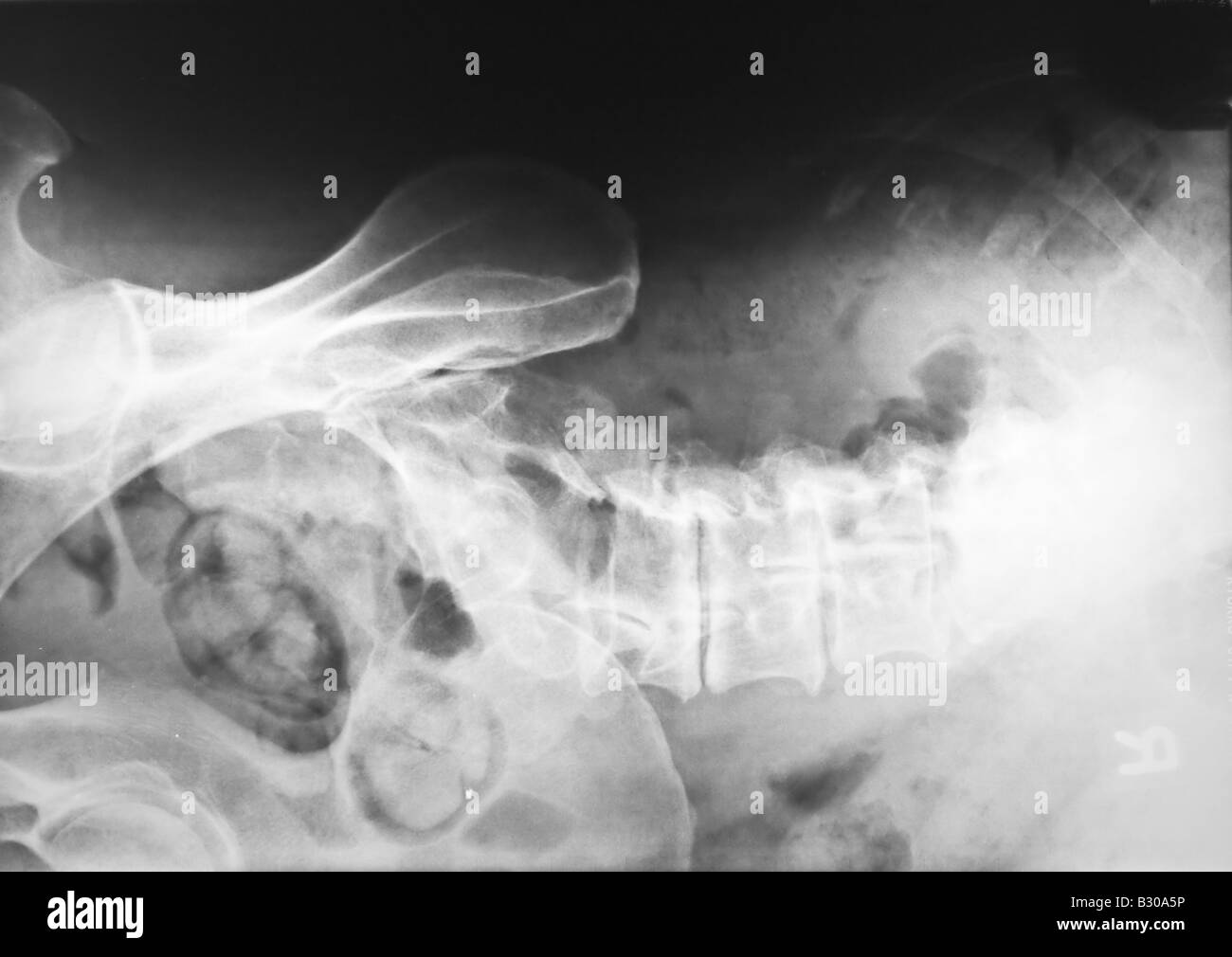 X ray of human lumbar spine Stock Photo - Alamy