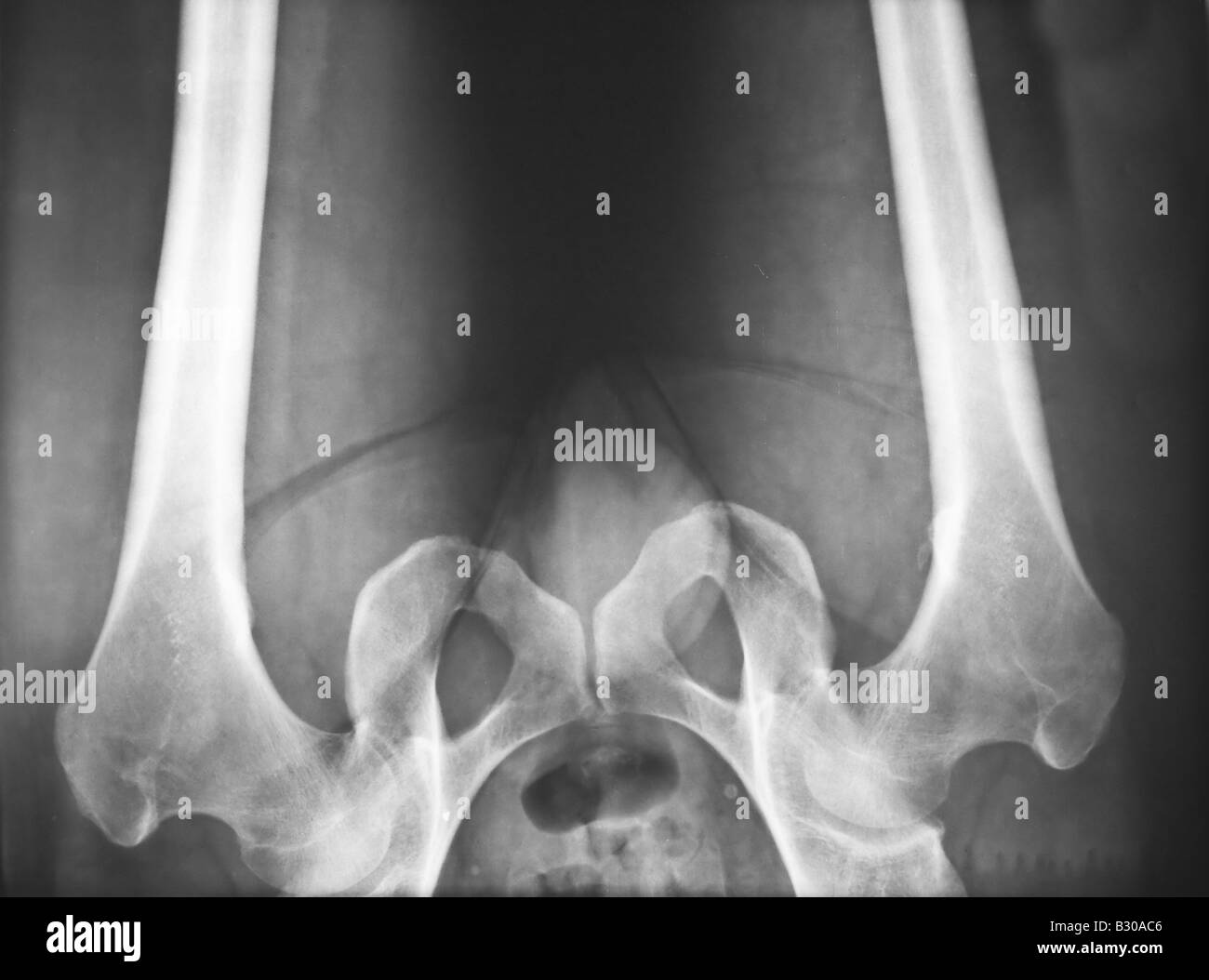 X ray of human hip joints Stock Photo