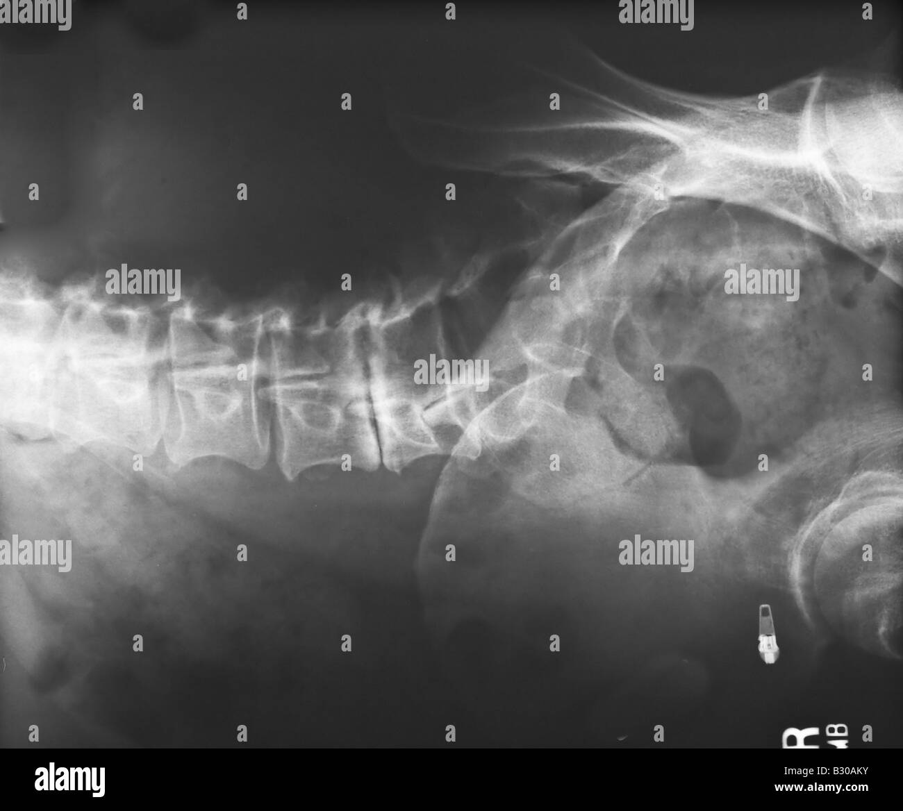 X ray of human lumbar spine Stock Photo - Alamy
