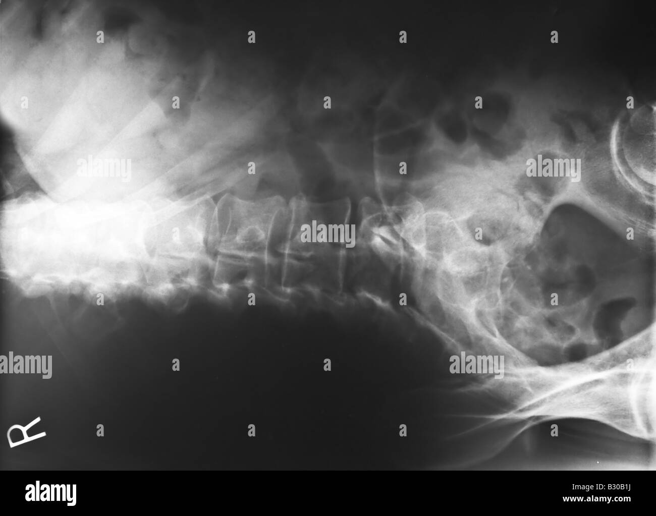 X ray of human lumbar spine Stock Photo - Alamy