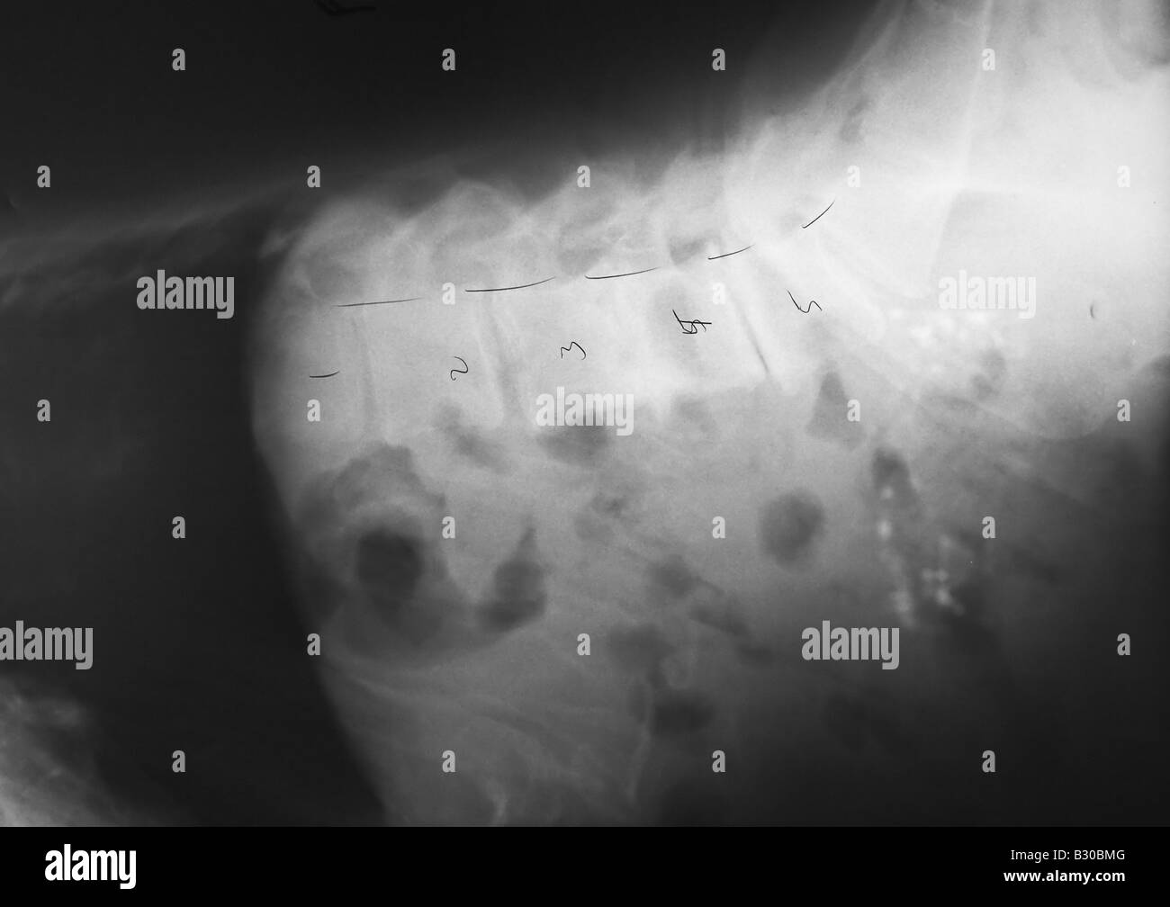 X ray of human lumbar spine Stock Photo - Alamy
