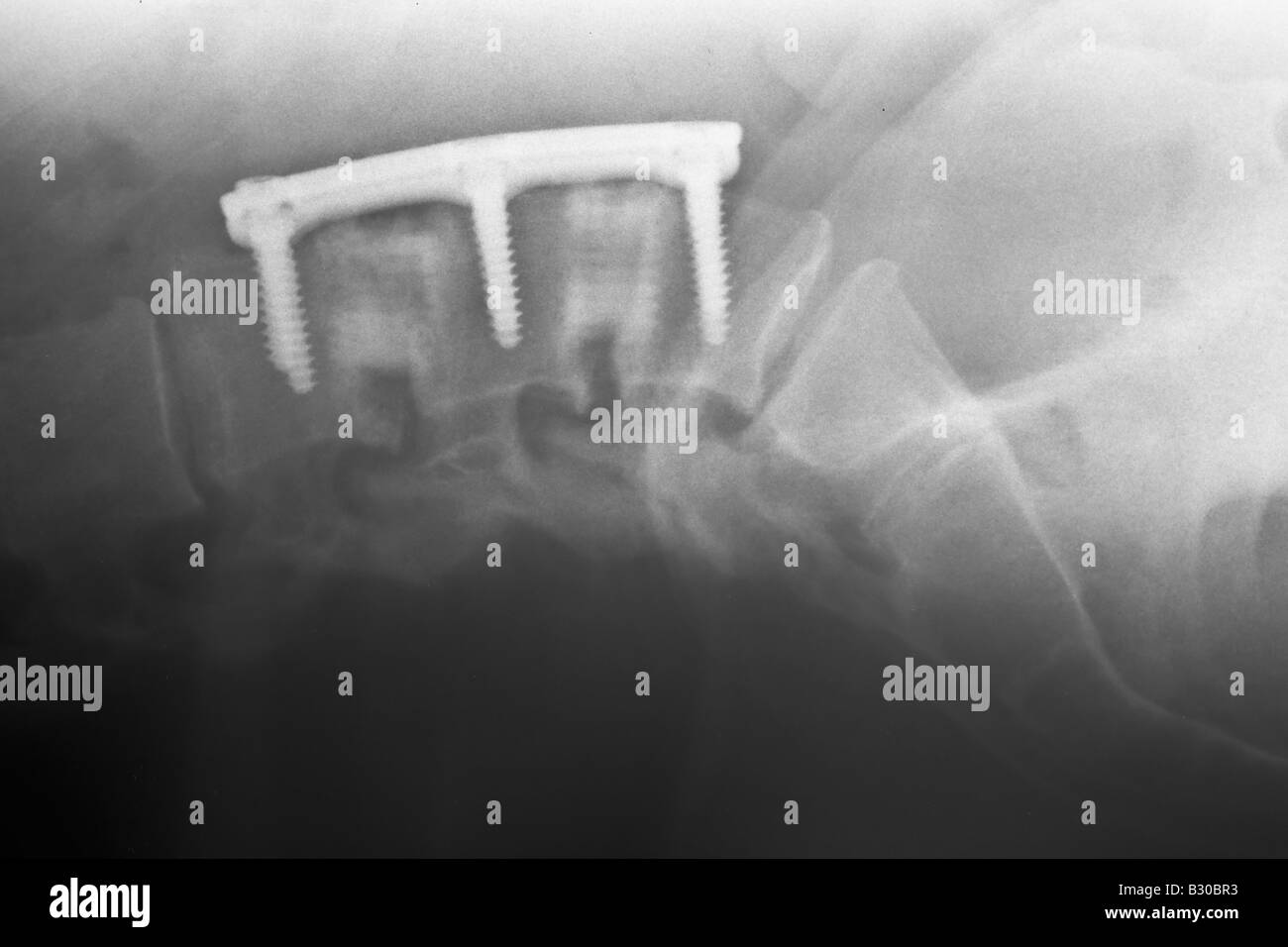 X ray of human lumber spine showing hardware used in an Anterior lumbar