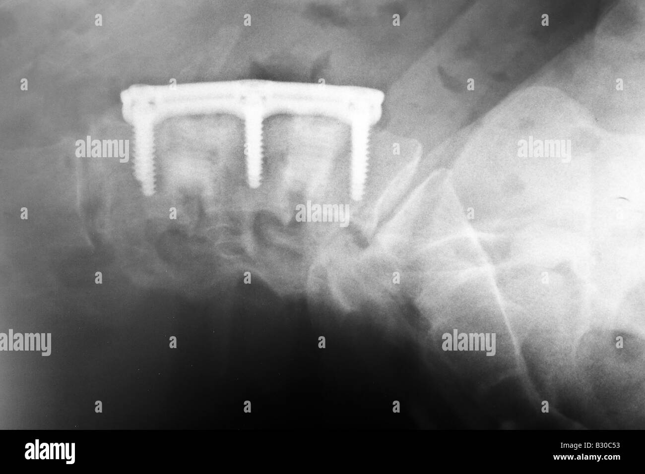 X ray of human lumber spine showing hardware used in an Anterior lumbar