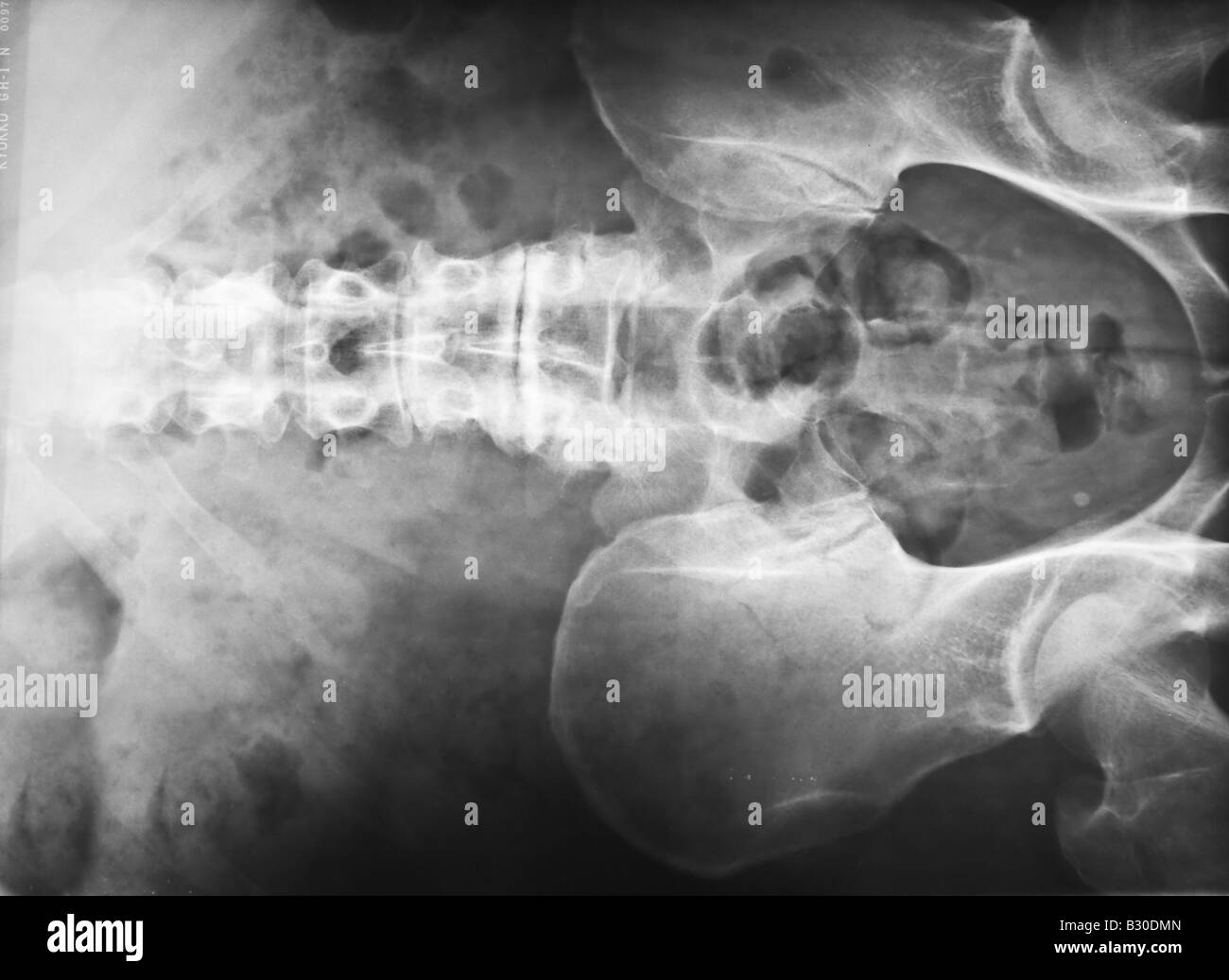 X ray of human lumbar spine Stock Photo - Alamy