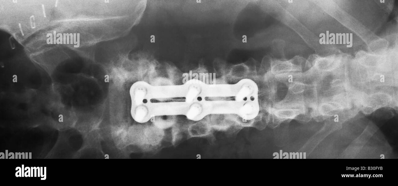 X ray of human lumber spine showing hardware used in an Anterior lumbar