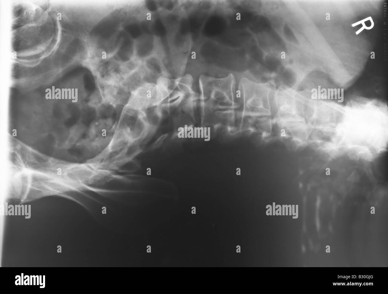 X ray of human lumbar spine Stock Photo - Alamy