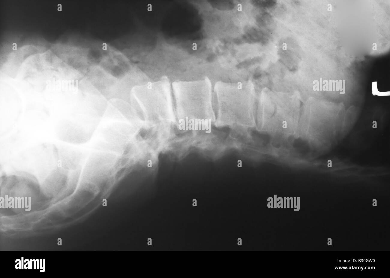 X ray of human lumbar spine Stock Photo - Alamy