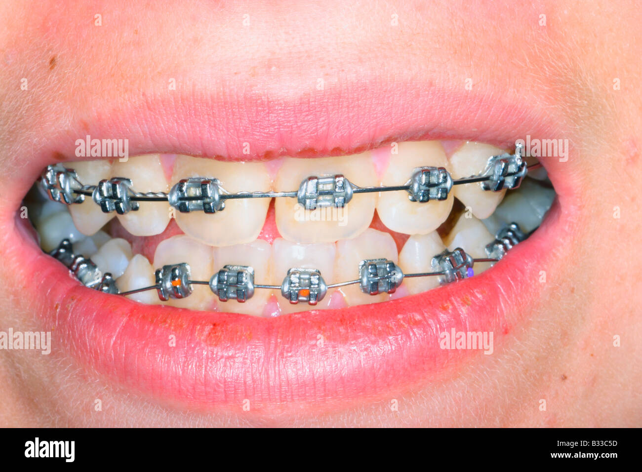 Closeup of young girl teeth showing braces Stock Photo Alamy