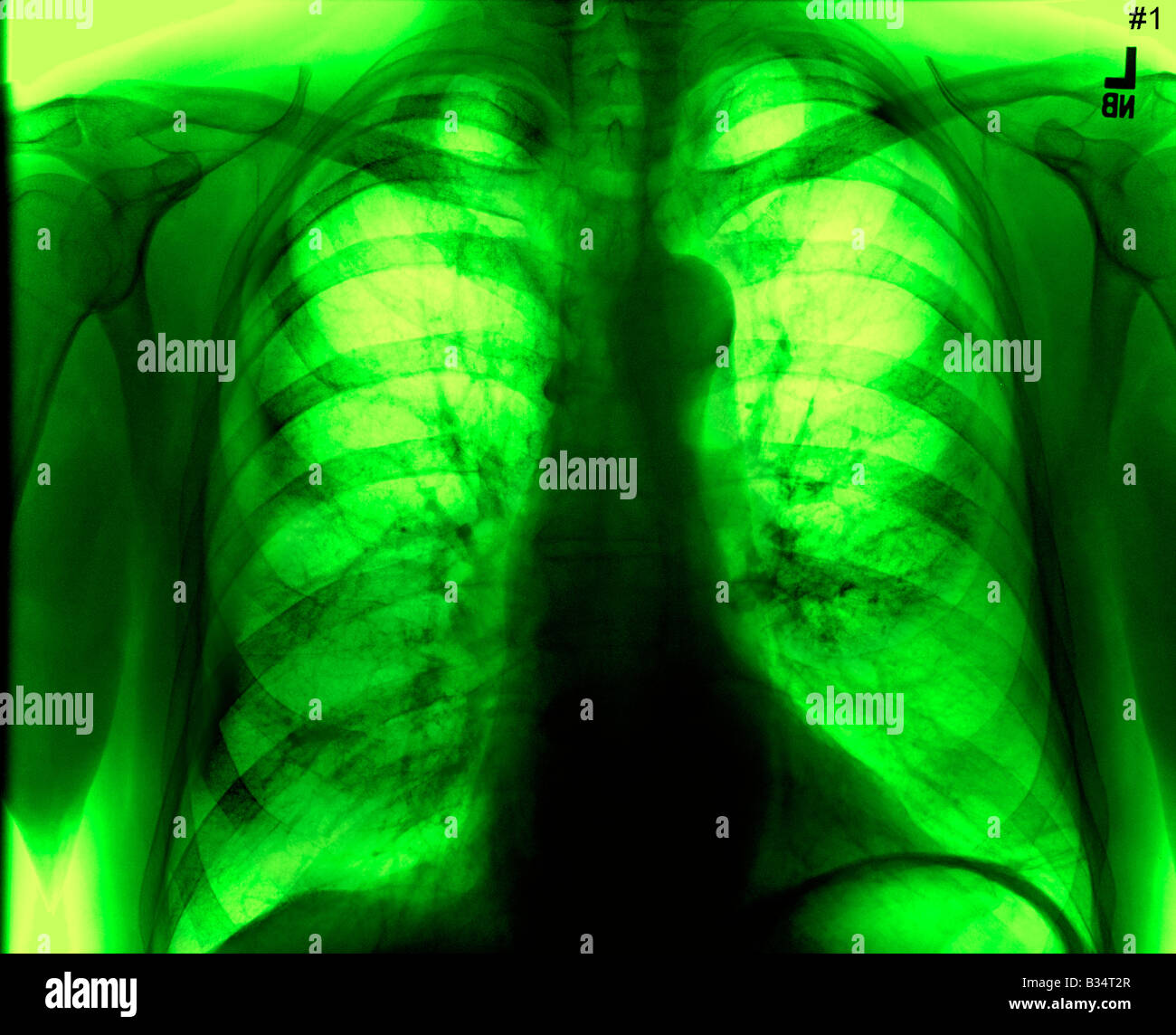 colored coded chest xray Stock Photo Alamy