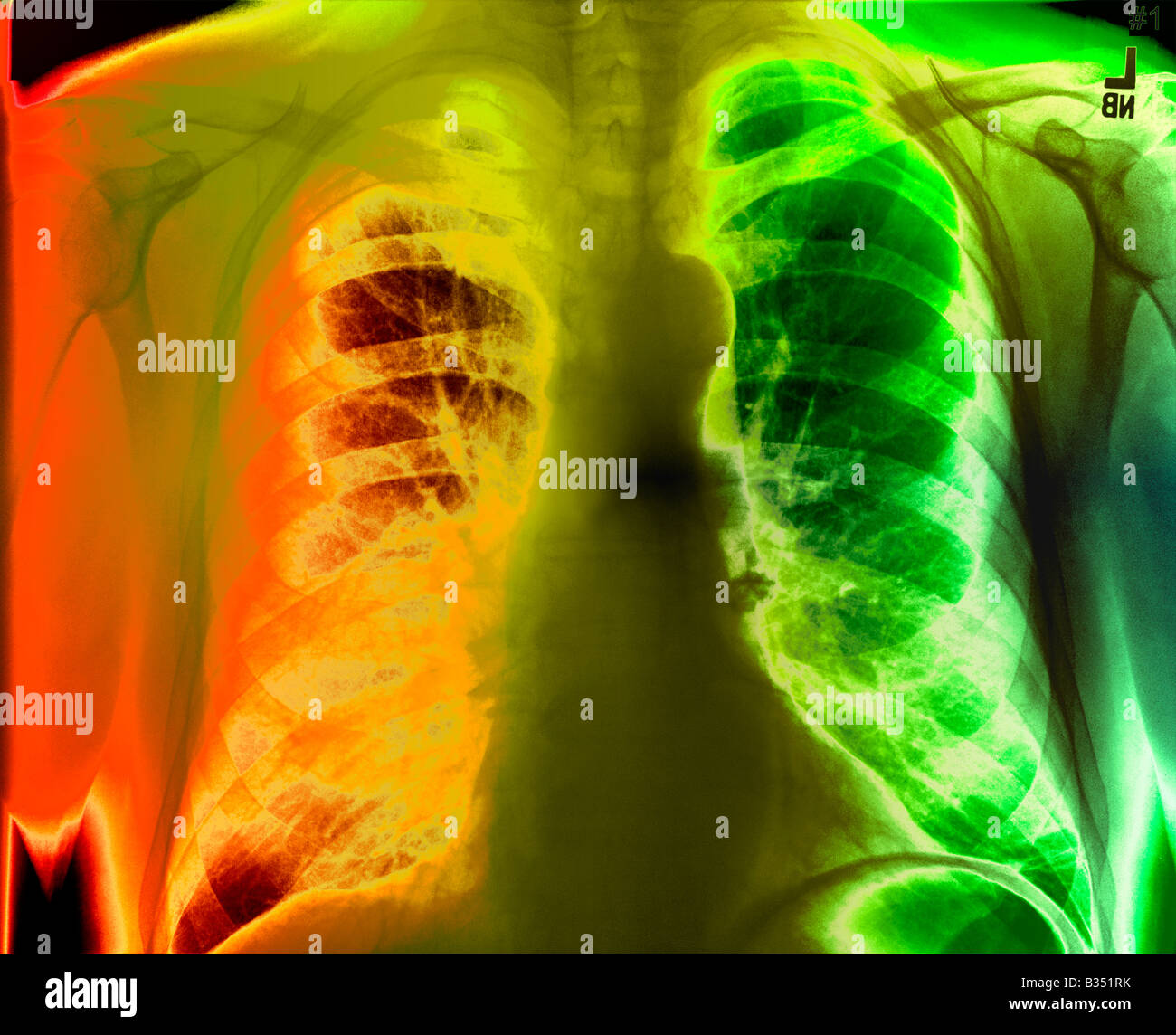 colored coded chest xray Stock Photo Alamy