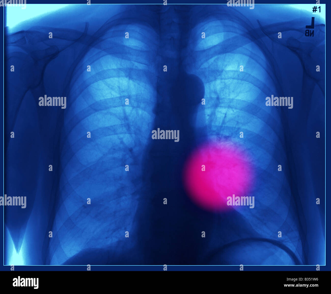 chest x-ray marked showing a faulty heart Stock Photo