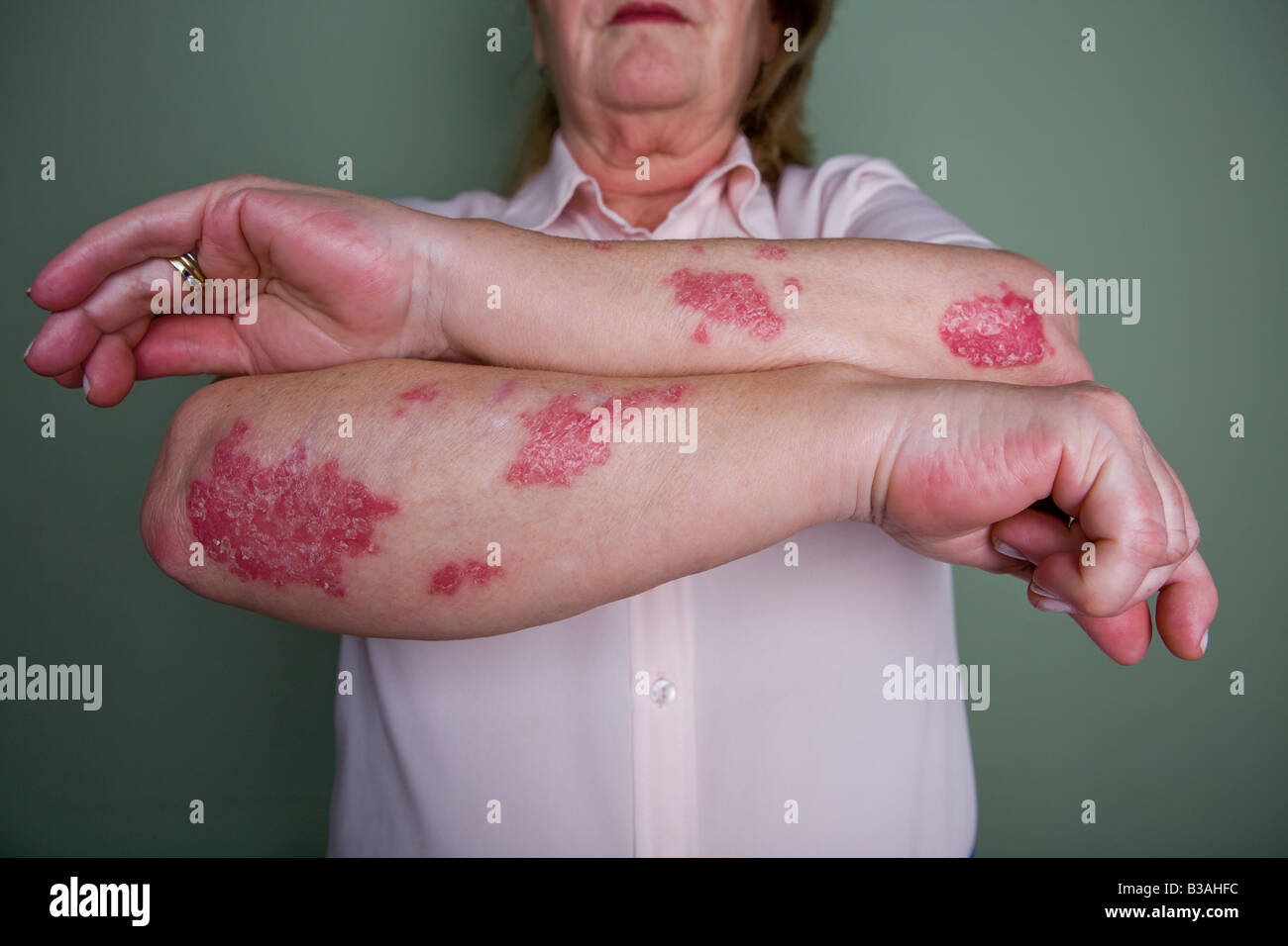Psoriasis on both forearms and psoriatic arthropathy in hands in a woman of 60 years old Stock Photo