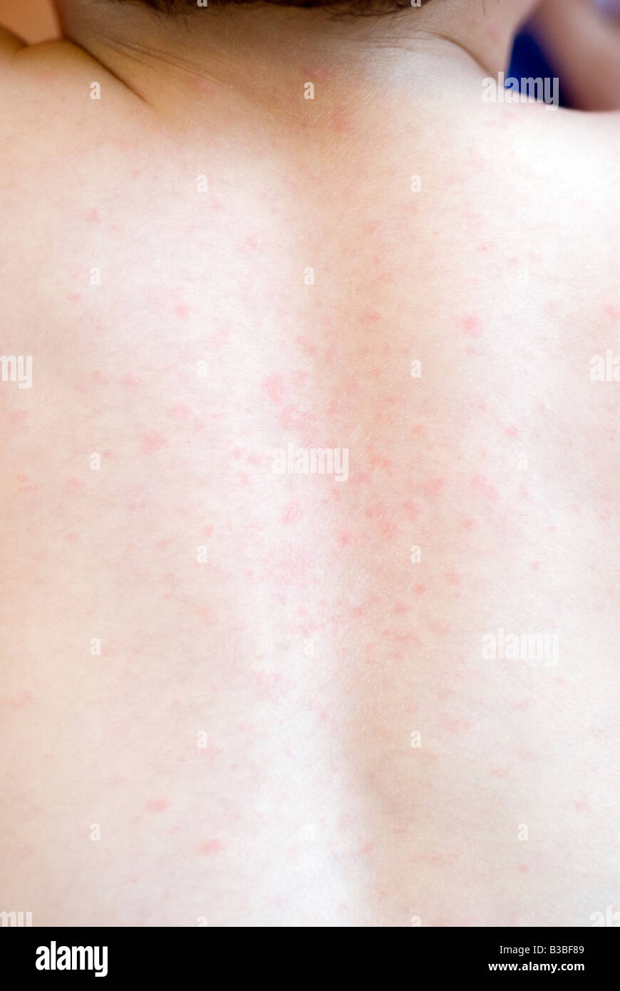 Coxsackie Virus High Resolution Stock Photography and Images Alamy