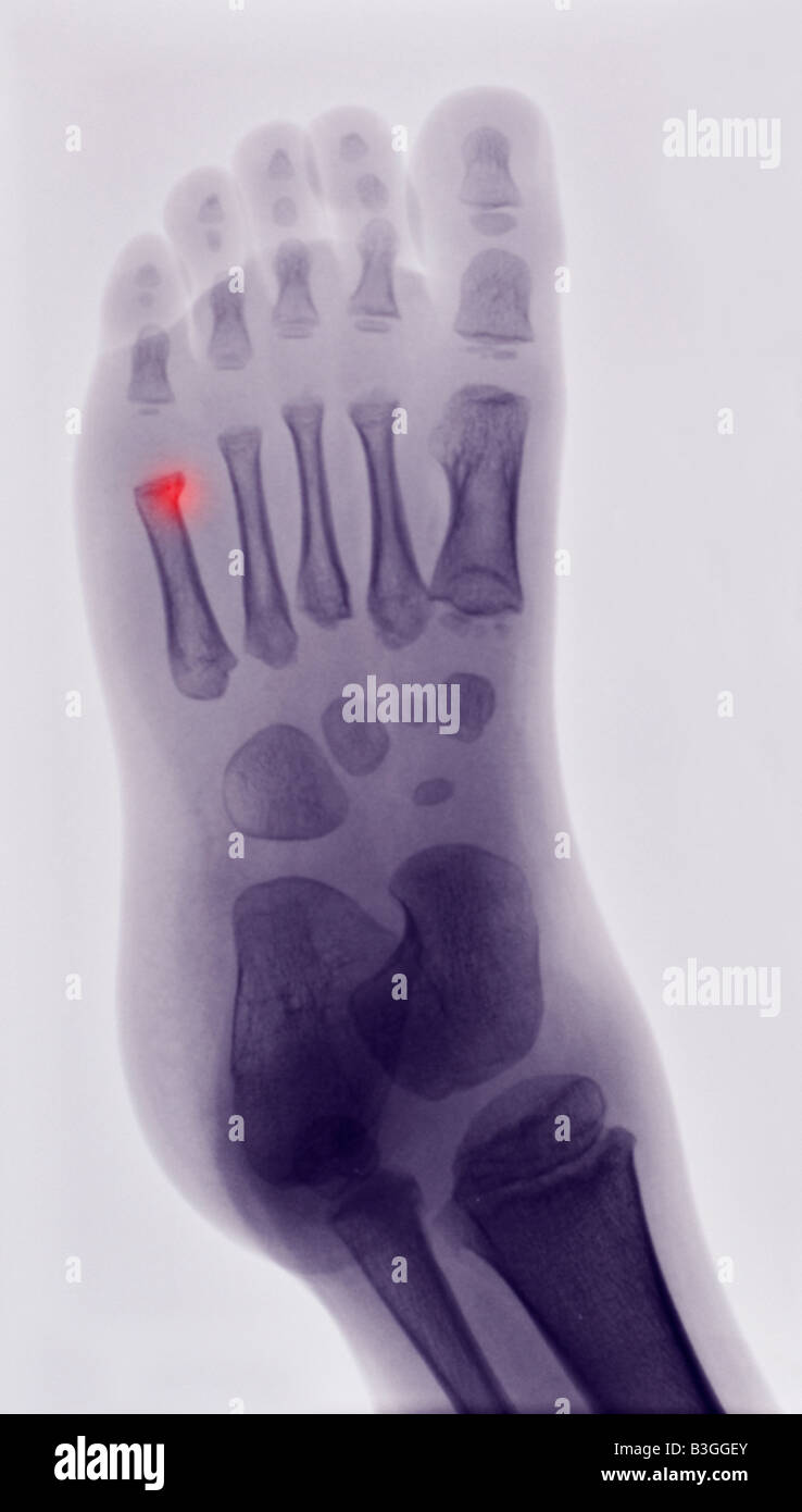 x ray of the foot of a boy showing a buckle fracture of the 5th