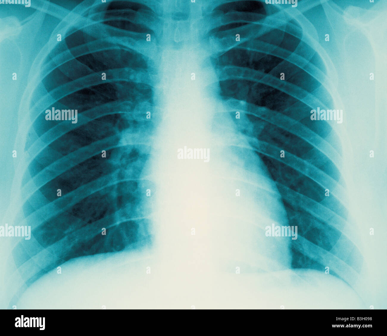 Closeup of chest xray diagnostic image showing lungs and rib cage Stock Photo Alamy