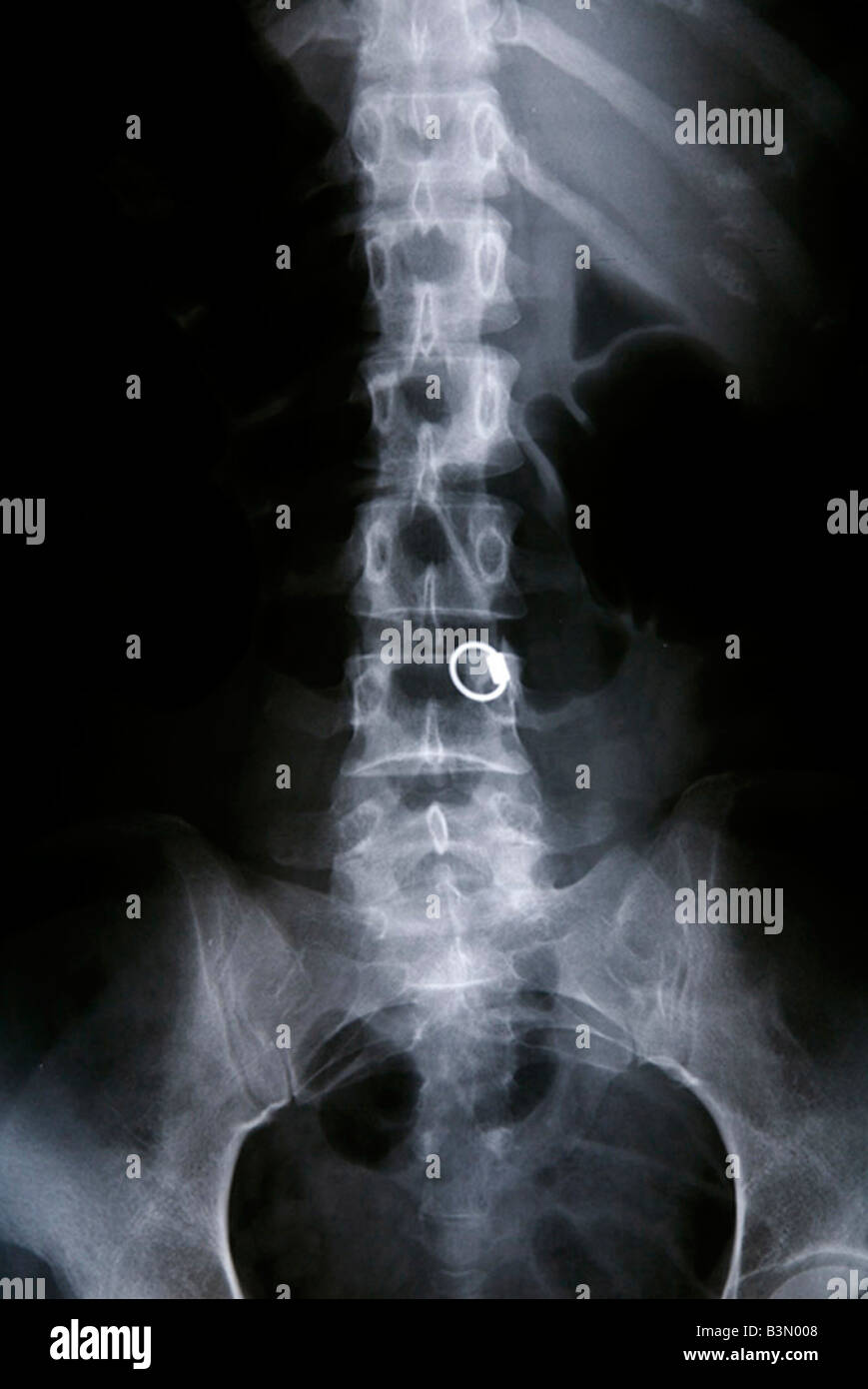 Cervical spine hi-res stock photography and images - Alamy