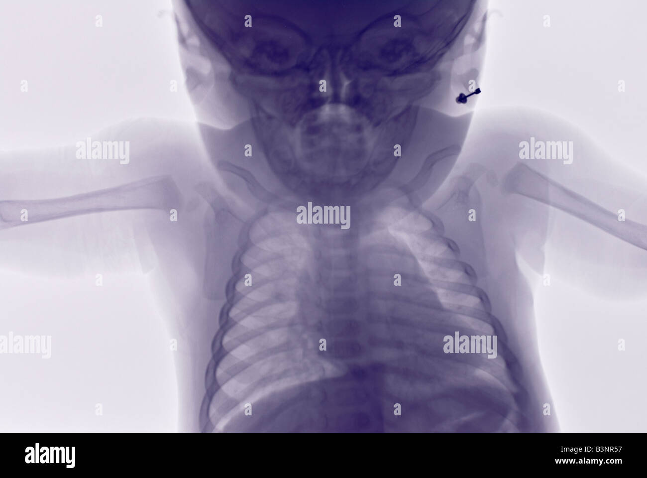 xray of the upper body of a 6 month old child suspected of having been physically abused Stock Photo