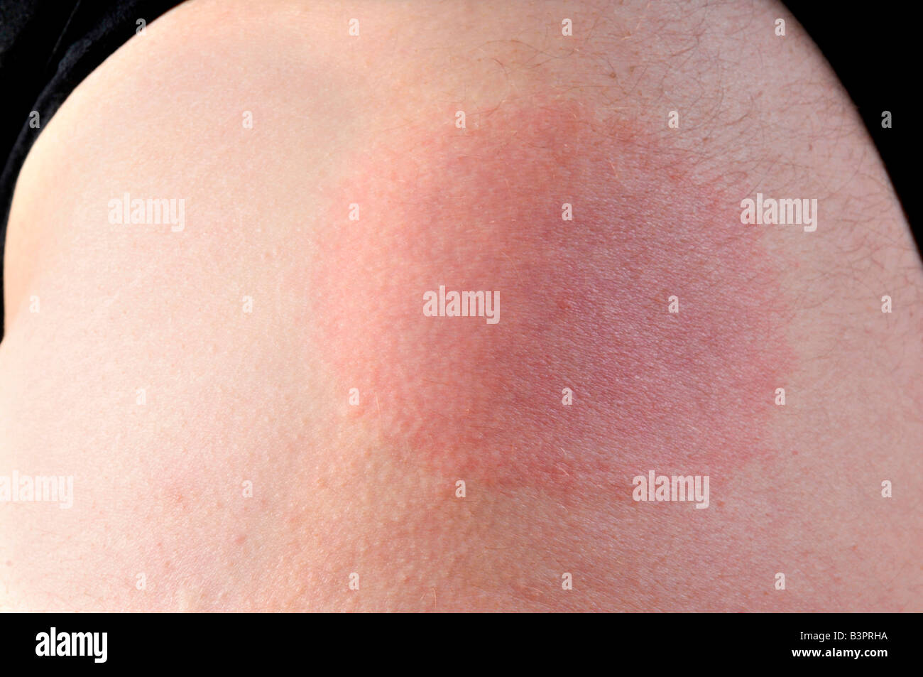 Skin rash, Erythema migrans, following a tick bite Stock Photo