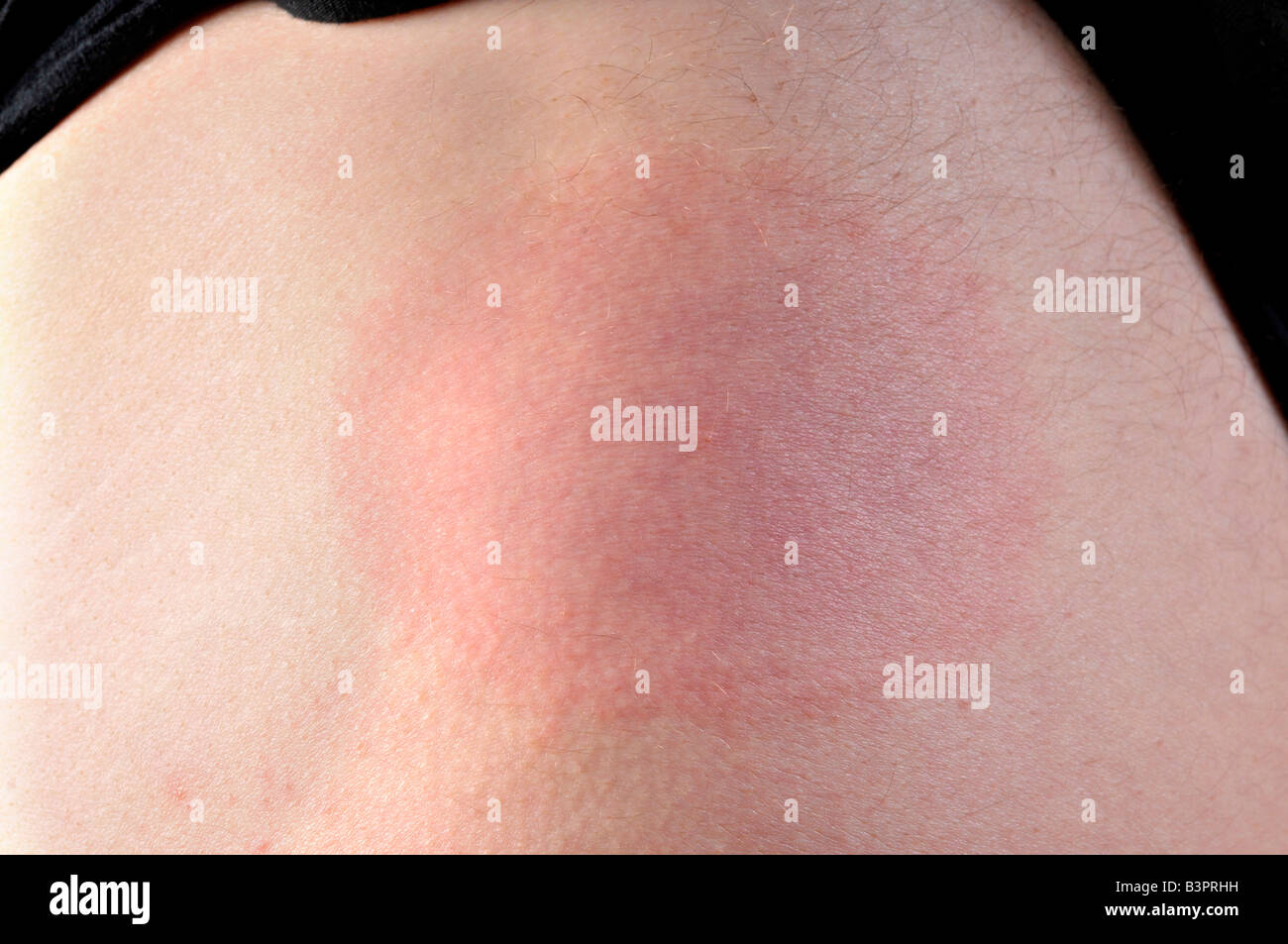 Skin rash, Erythema migrans, following a tick bite Stock Photo