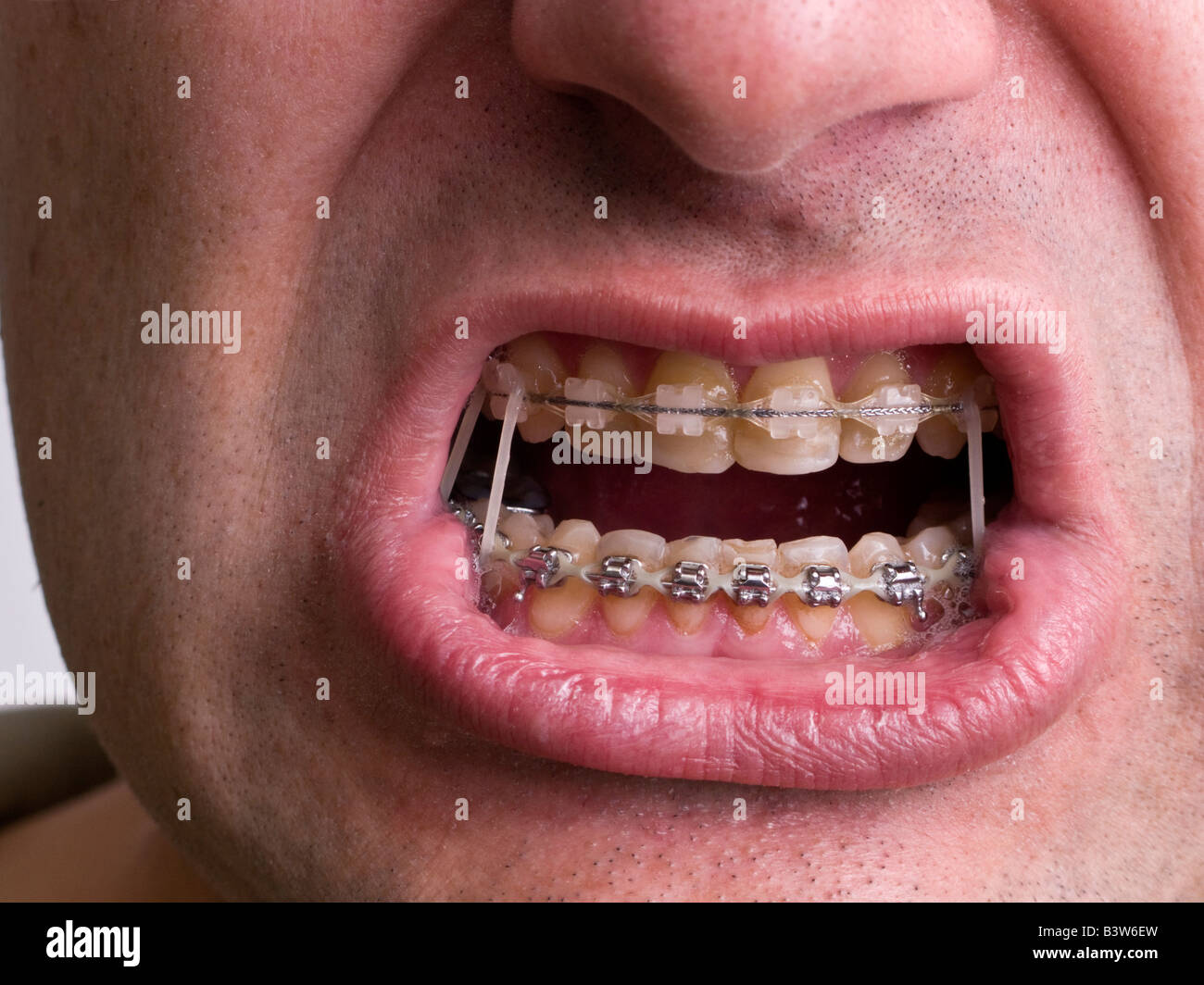 Adult male with mouth open showing braces Stock Photo