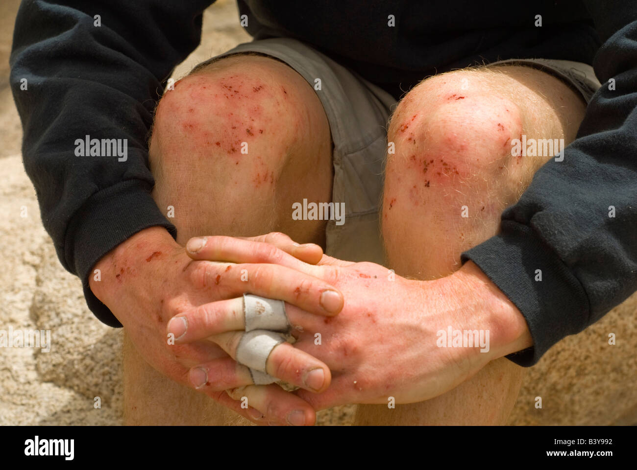 USA, California, Joshua Tree National Park.  Abrasions on a rock climber's knees and hands after a week of climbing.  (MR) Stock Photo