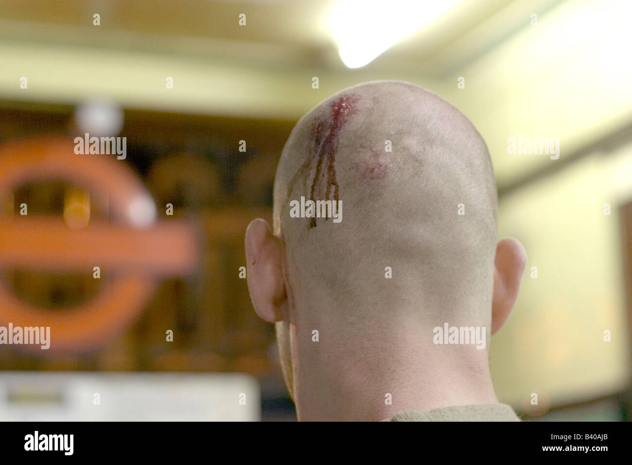 back of skinheads head with cut blood at tube station Stock Photo