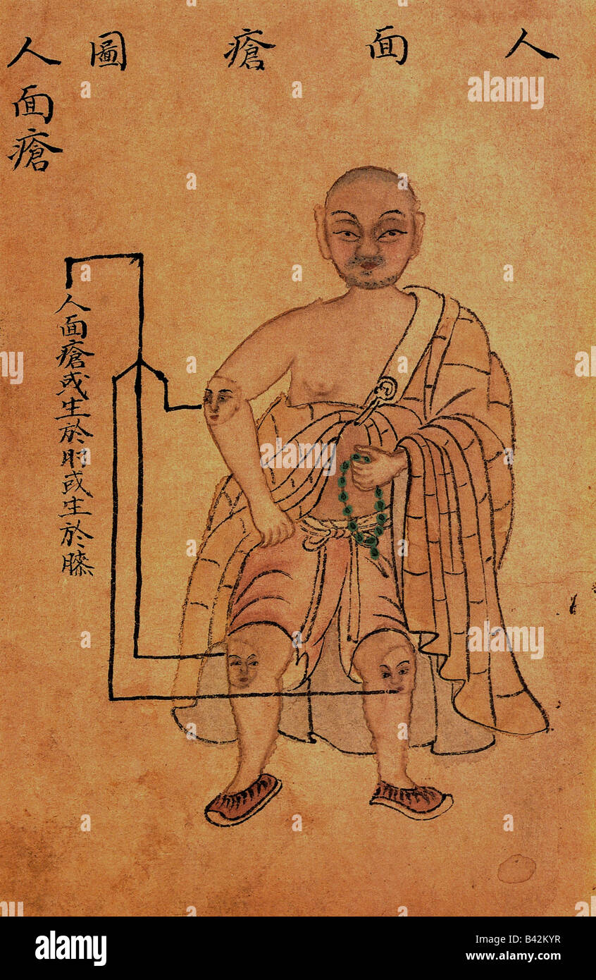 medicine, Huichun, Chinese medicine, symptoms, illustration of abscesses with human face, 1742, Stock Photo