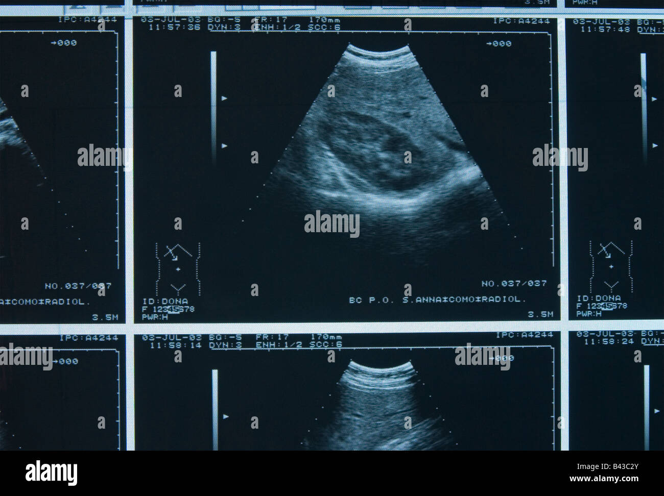 abdominal ultrasound scan Stock Photo