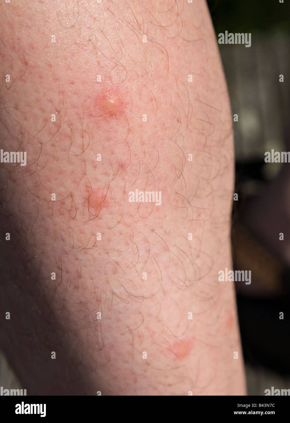 Mosquito bites on leg Stock Photo
