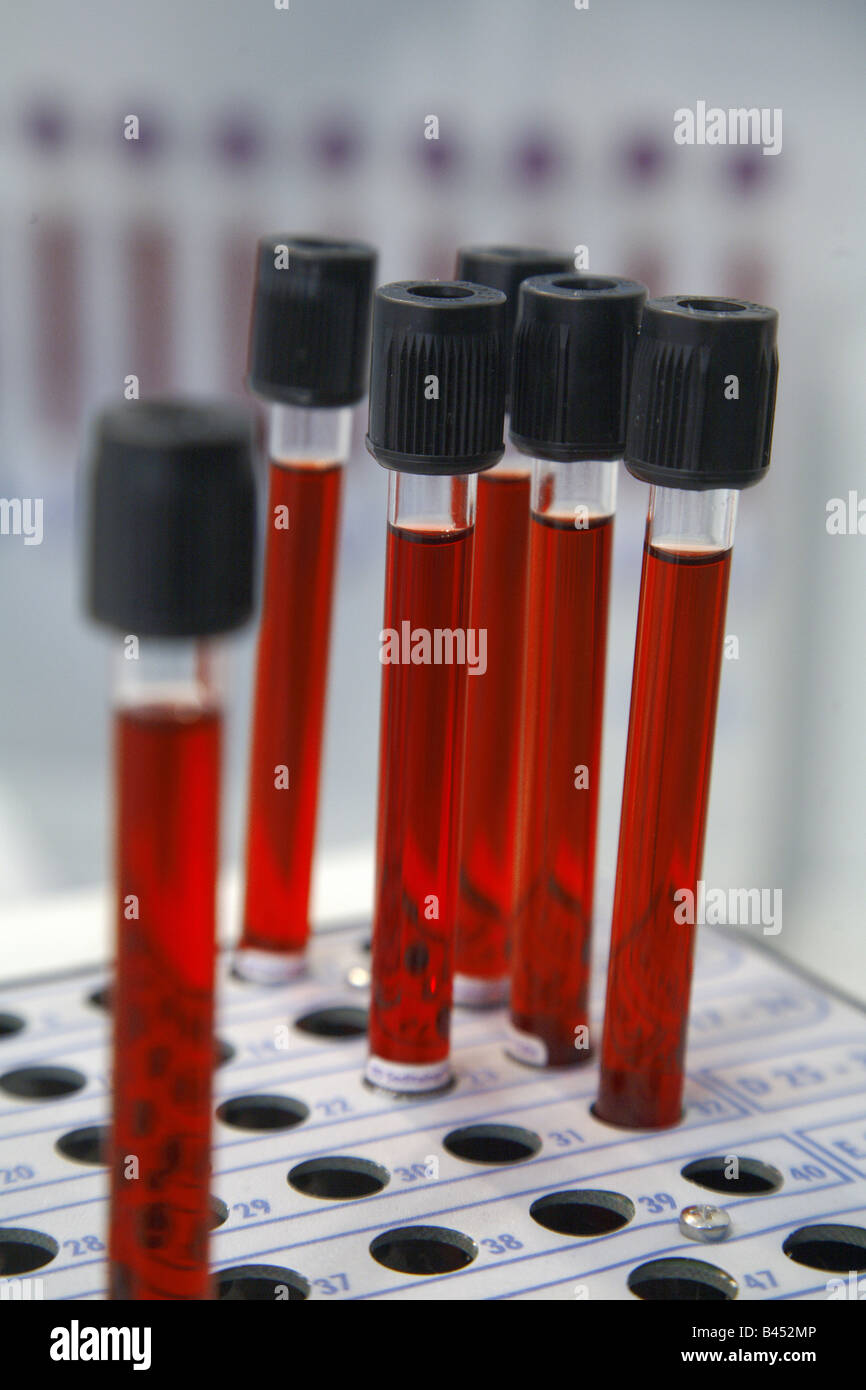 Erythrocyte Sedimentation Rate (ESR) Blood Test