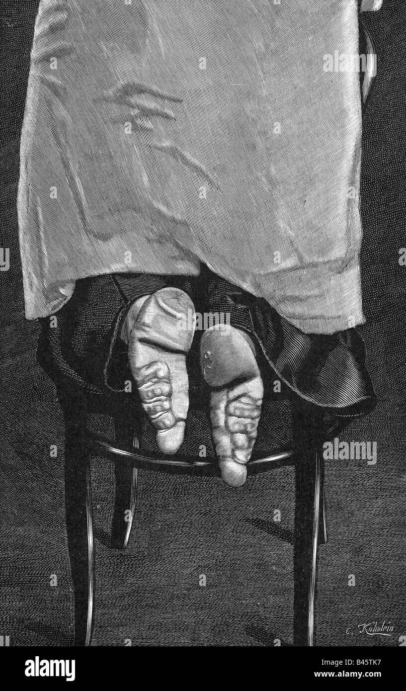 medicine, abnormalities, affectedly distortion, foot bandage, feet of a Chinese woman, wood engraving by C. Koehnlein, after photography, circa 1900, Stock Photo