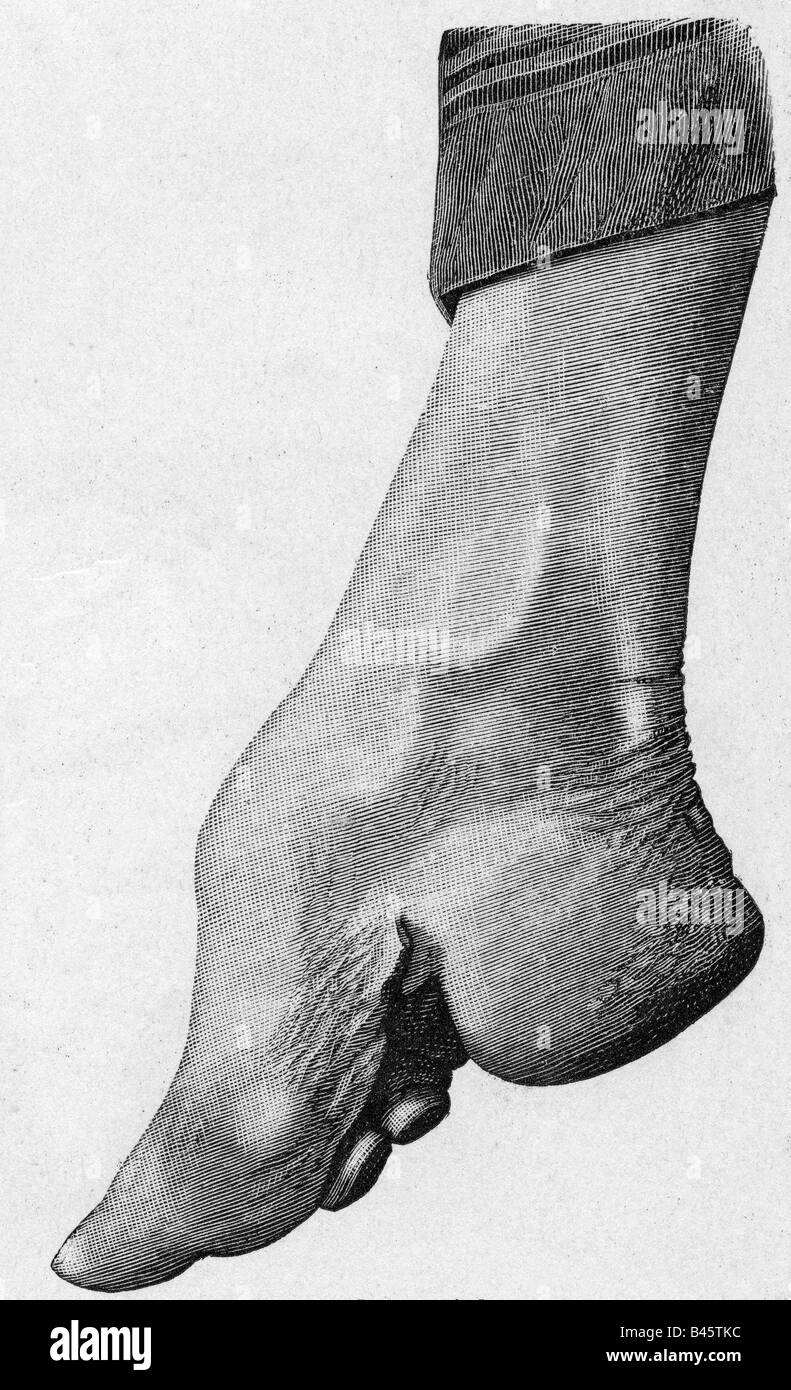 medicine, abnormalities, affectedly distortion, feet bandage, right foot of a Chinese woman, wood engraving after photography, circa 1900, Stock Photo
