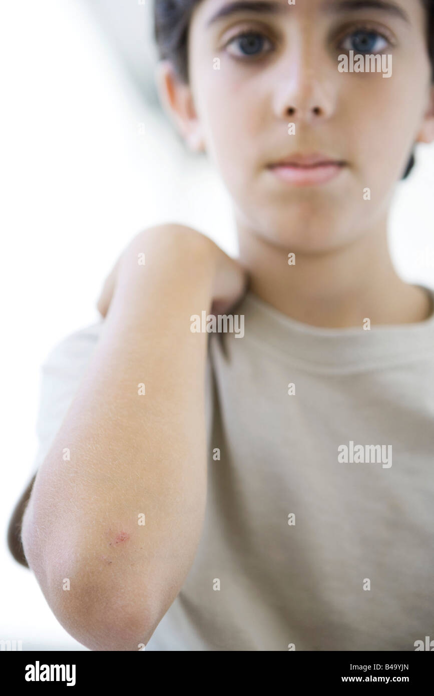 Boy showing scraped elbow, looking at camera Stock Photo
