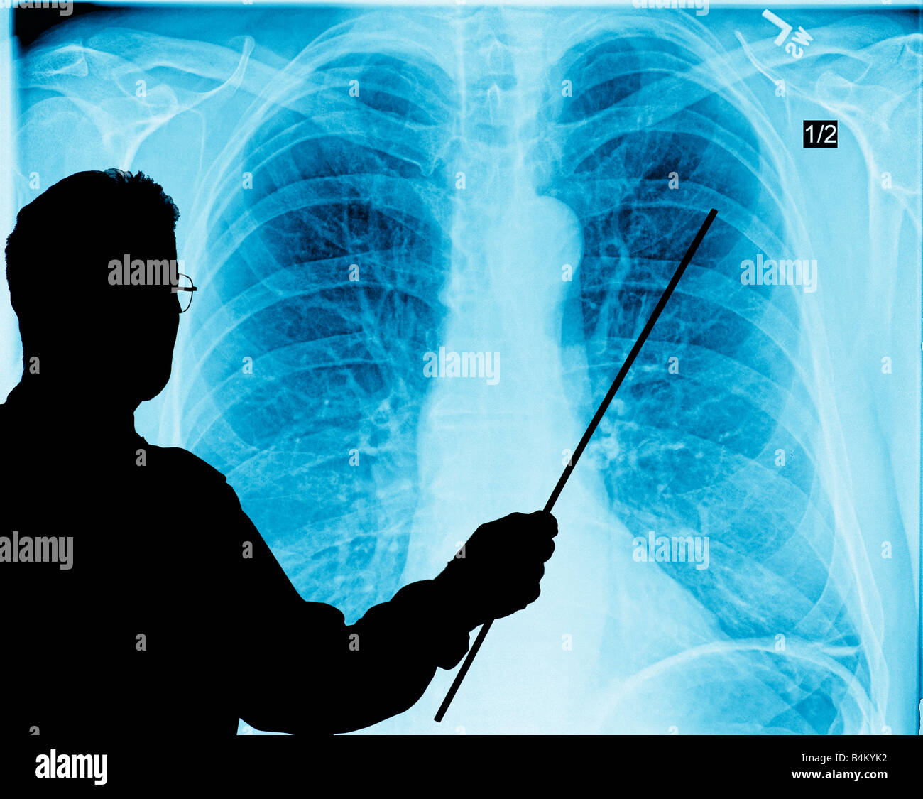 doctor studying chest Xray projection on computer screen Stock Photo