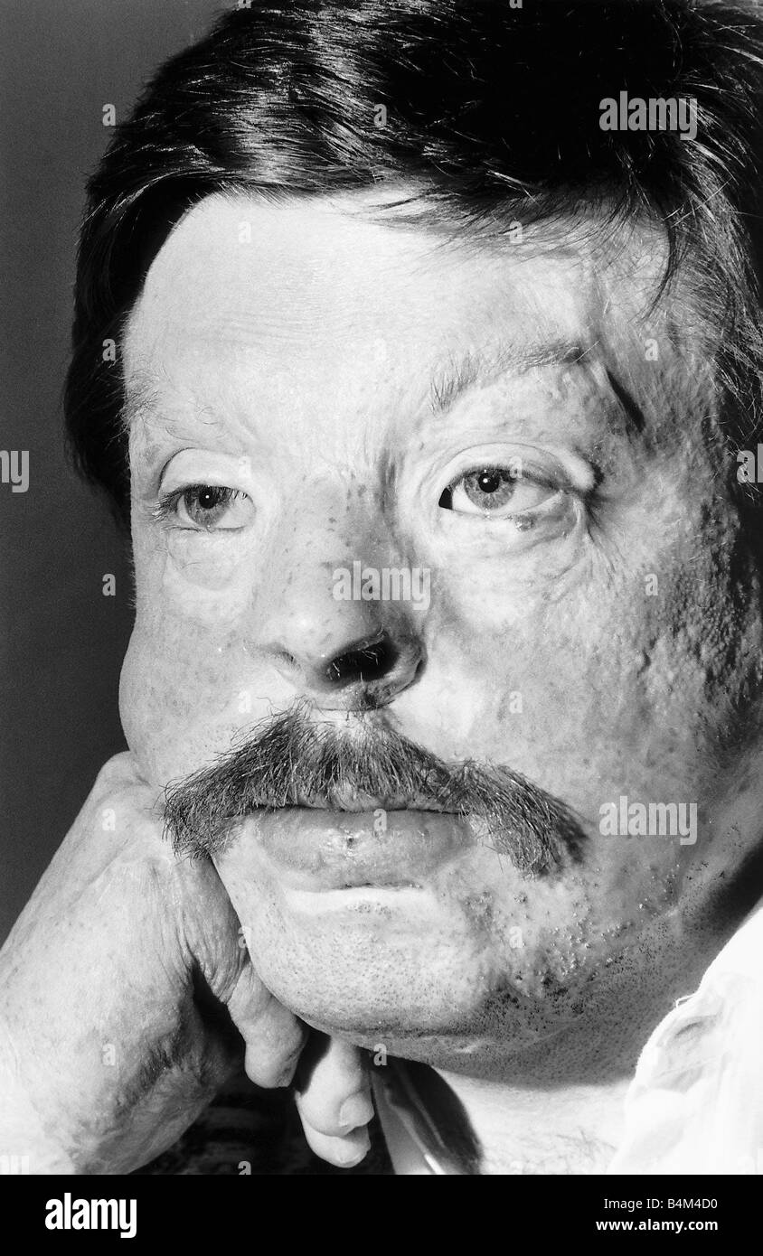 Soldier Simon Weston scarred during an Argentine attack on Sir Galahad